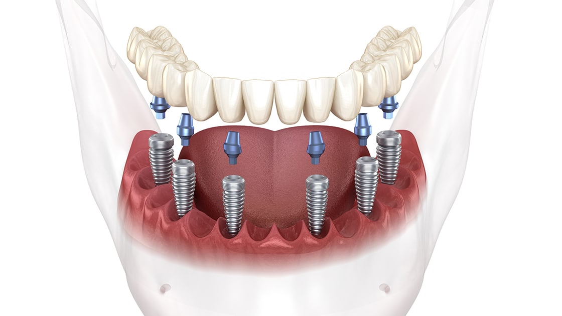 Implant Retained Denture Photo